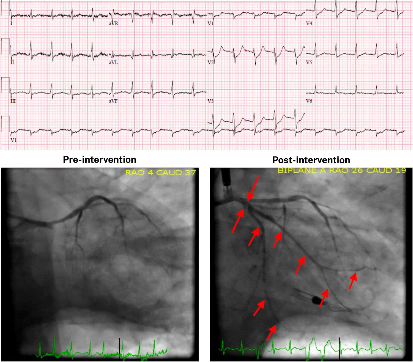 Find out if that STEMI was real