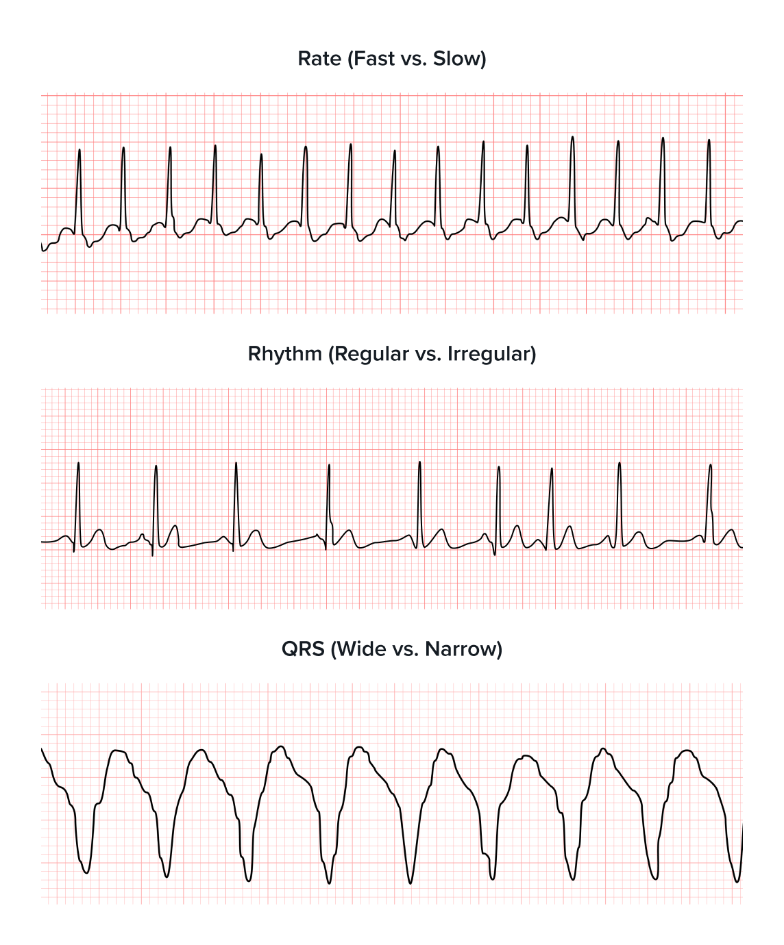 Rapidly Interpret Real ECGs