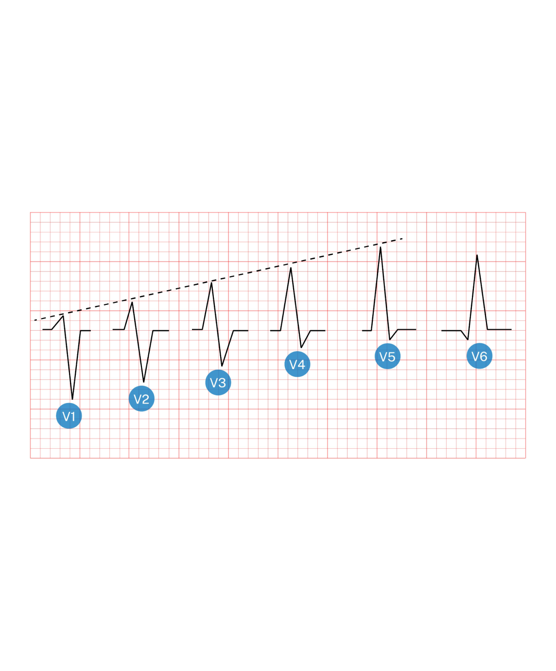 Understand R Wave Progression