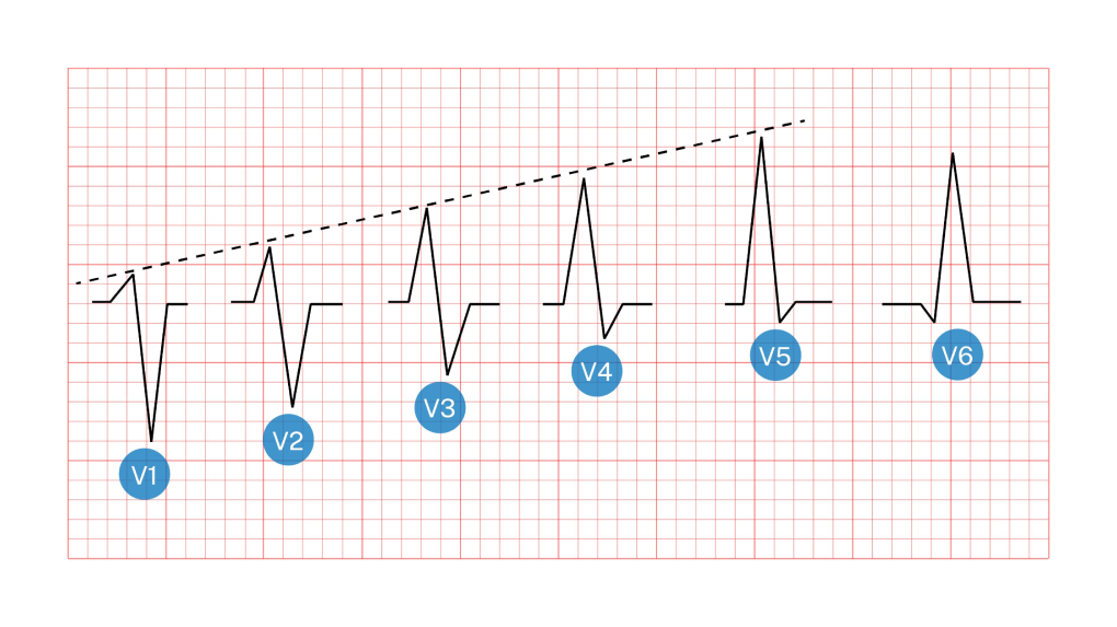 Understand R Wave Progression