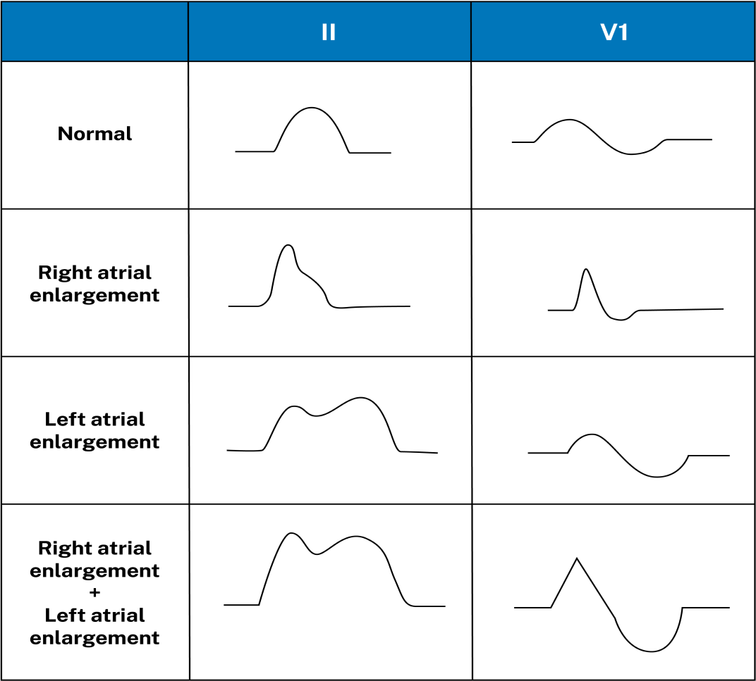 The P wave corresponds to atrial depolarization