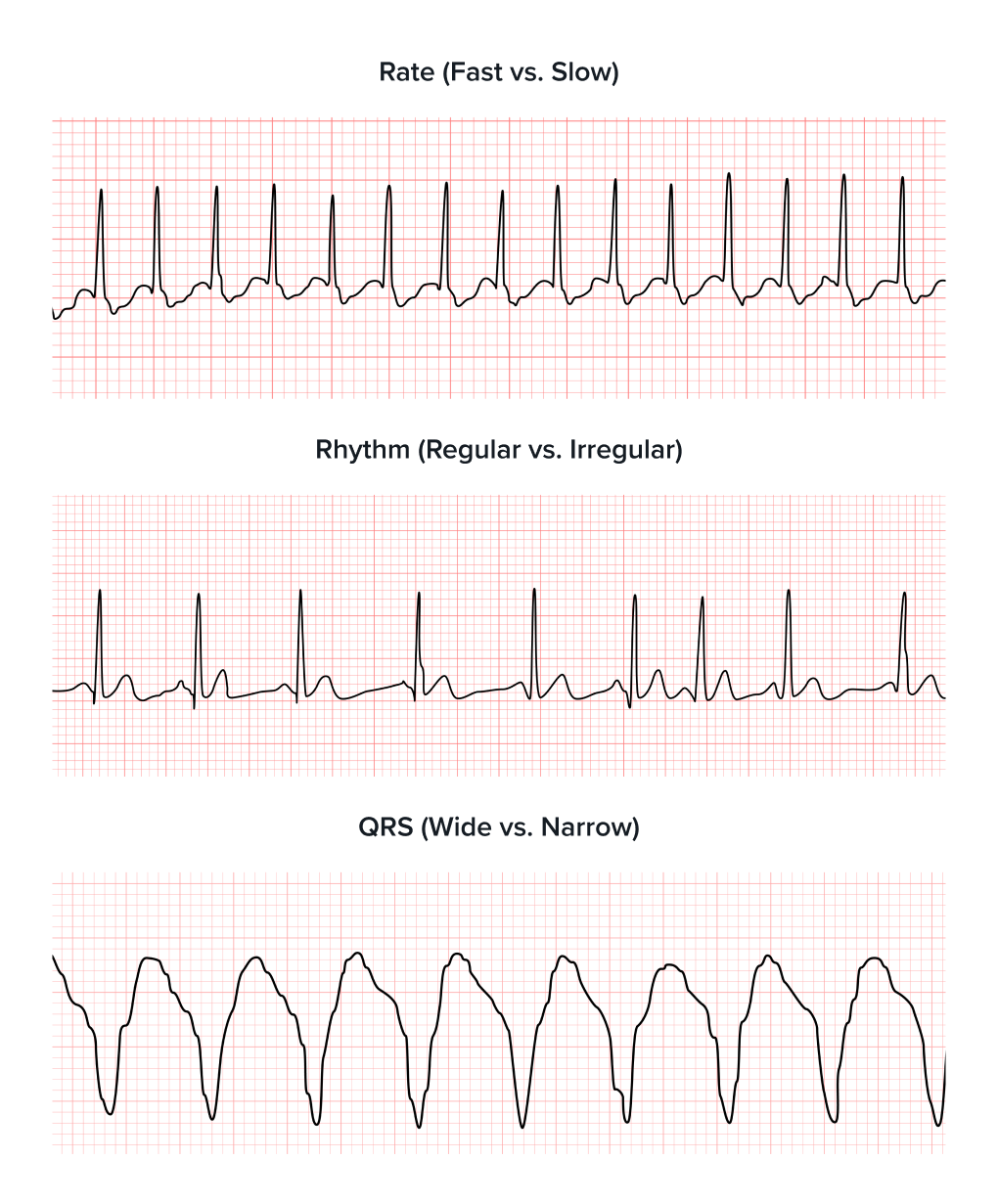 Rapidly Interpret Real ECGs