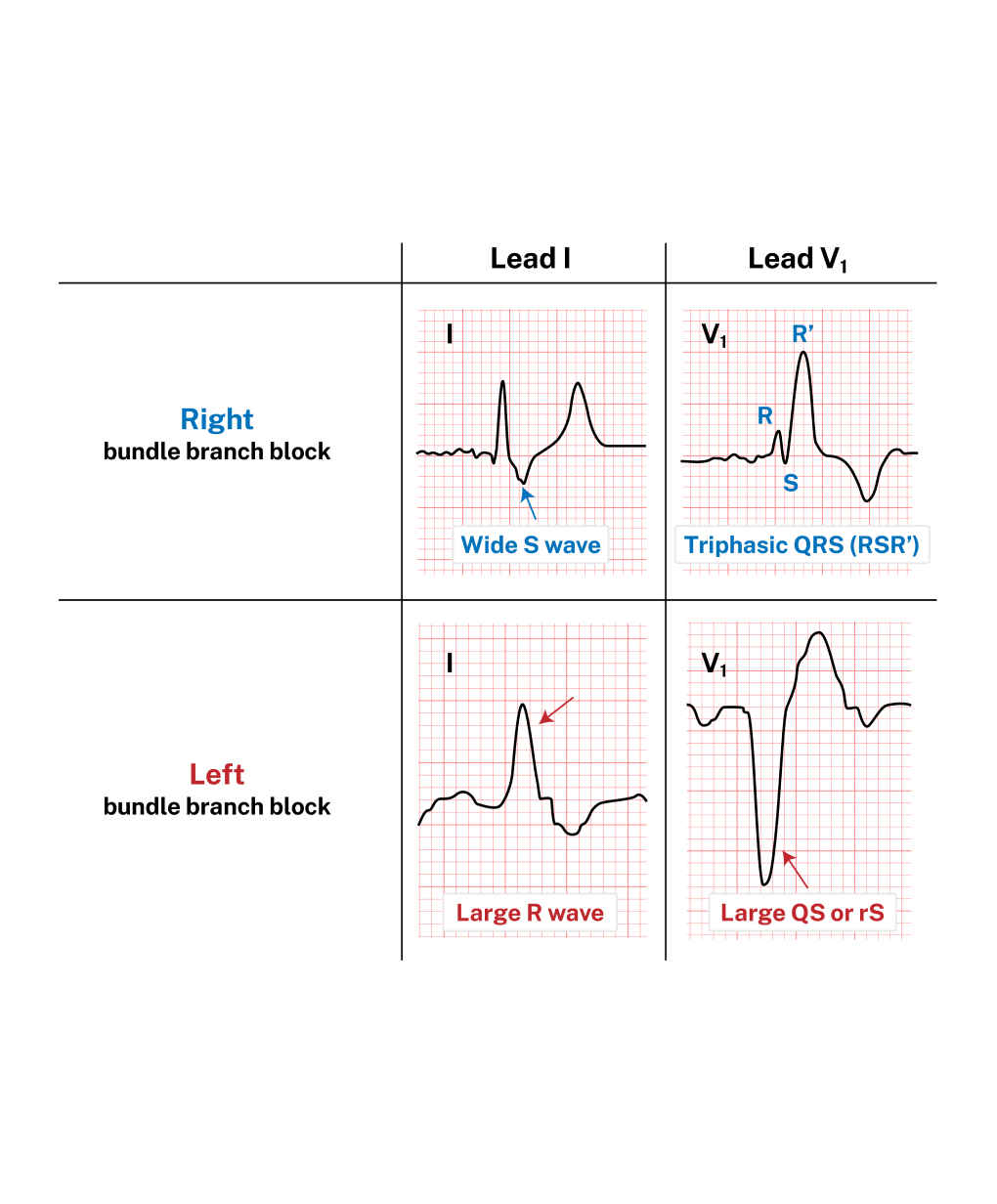 Easy Identification of
            Bundle Branch Blocks