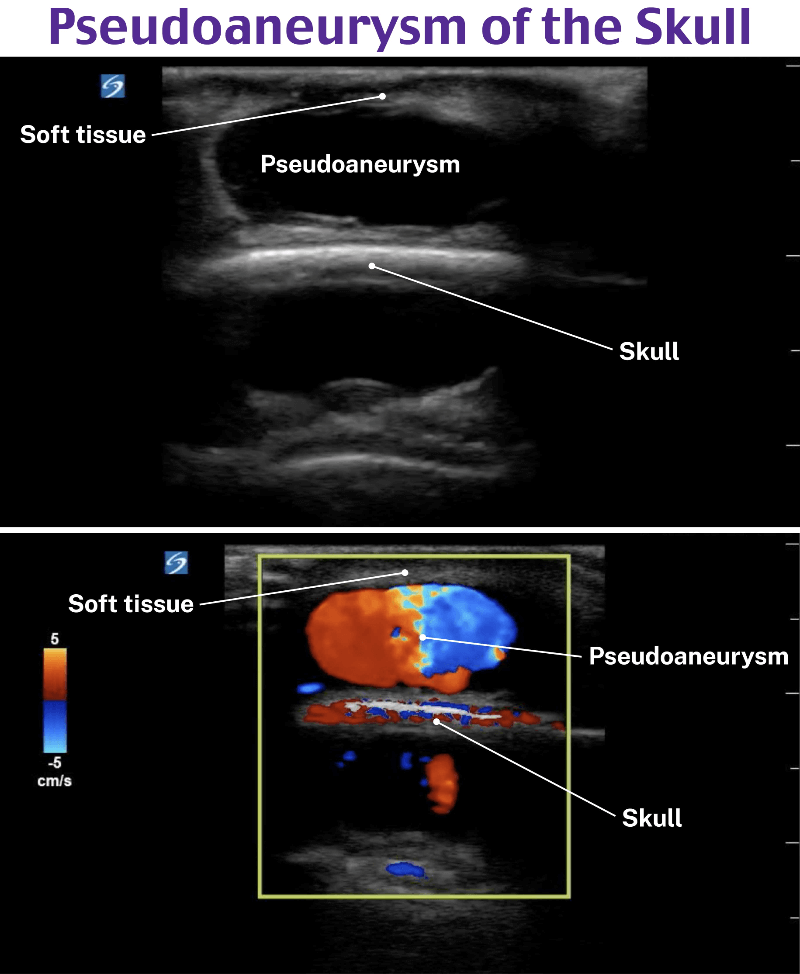 US Pseudoaneurysm of skull