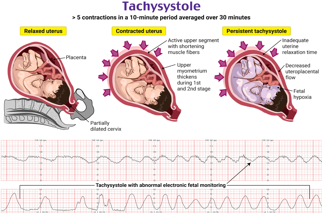 Tachysystole