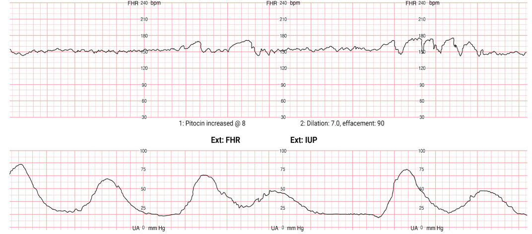  Fetal heart rate variability