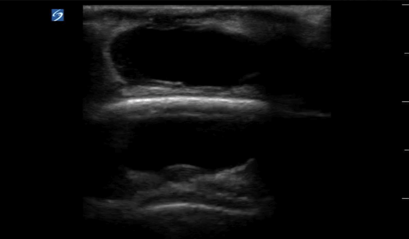 US Pseudoaneurysm of skull for question